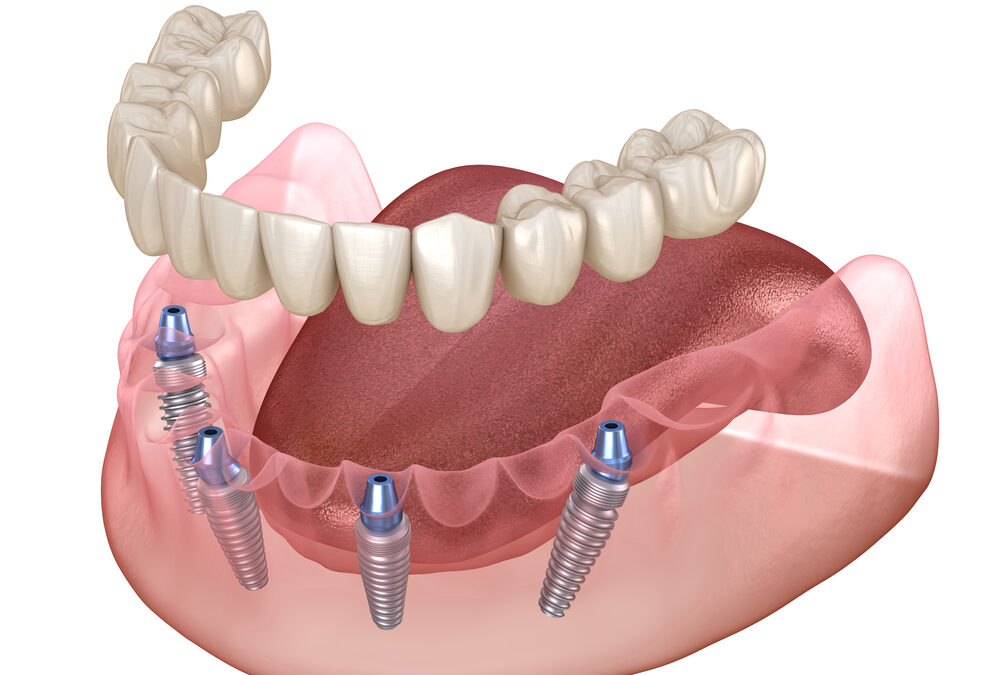 All-On-4: Dental Implants Of Innovation And Restoration