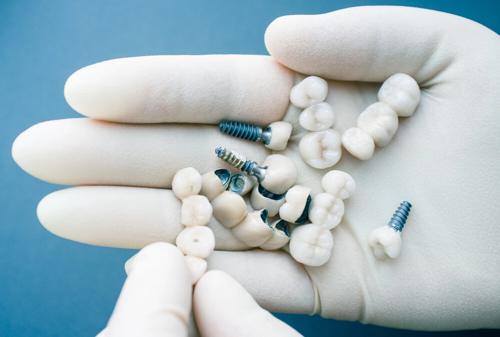 Missing Teeth? Discover Why Dental Implants Are the Gold Standard